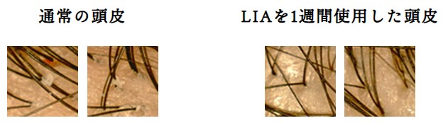 LIAスカルプシャンプーを1週間使用した頭皮