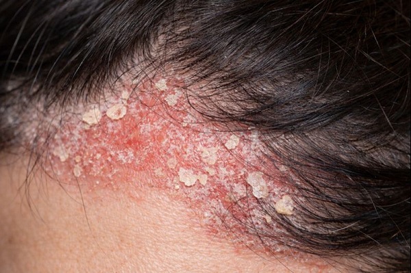 脂漏性皮膚炎とマラセチア菌の関係